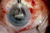 cataract extraction 3.jpg (282551 bytes)