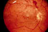 diabetci retinopathy NV flat.jpg (315573 bytes)