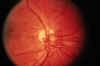diabetic retinopathy NVD.jpg (232676 bytes)